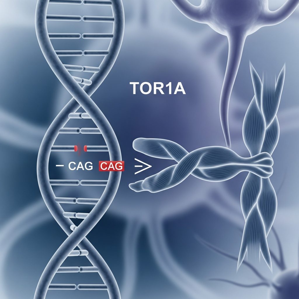 Диагностика первичной дистонии 1 типа